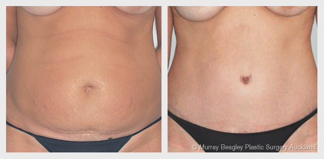 before after Abdominoplasty tummy tuck surgery