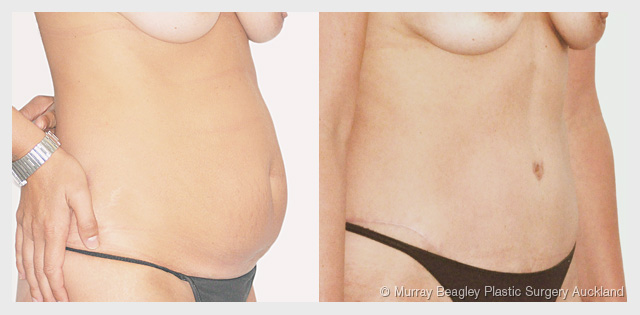 before after Abdominoplasty tummy tuck surgery