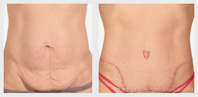before after Abdominoplasty tummy tuck surgery