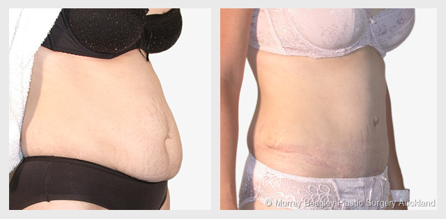 before after Abdominoplasty tummy tuck surgery