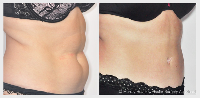 before after Abdominoplasty tummy tuck surgery