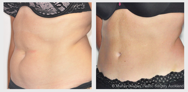 before after Abdominoplasty tummy tuck surgery