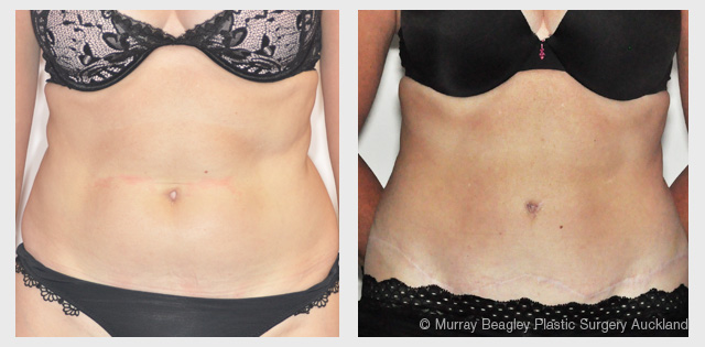before after Abdominoplasty tummy tuck surgery