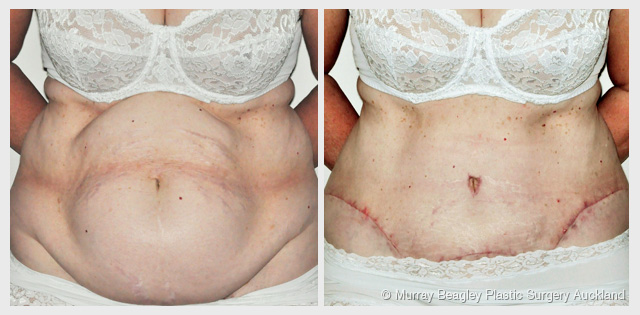 before after Abdominoplasty tummy tuck surgery