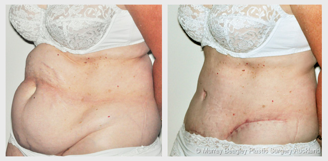 before after Abdominoplasty tummy tuck surgery