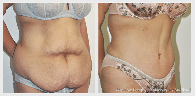 before after Abdominoplasty tummy tuck surgery