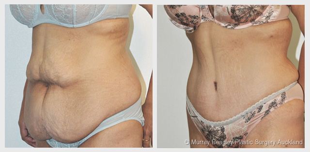 before after Abdominoplasty tummy tuck surgery