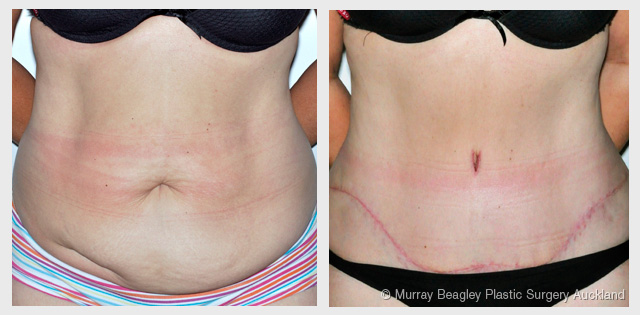 before after Abdominoplasty tummy tuck surgery