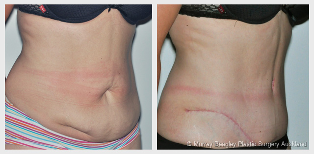 before after Abdominoplasty tummy tuck surgery