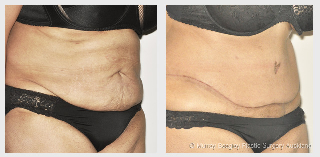 before after Abdominoplasty tummy tuck surgery