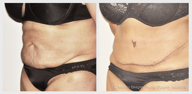 before after Abdominoplasty tummy tuck surgery