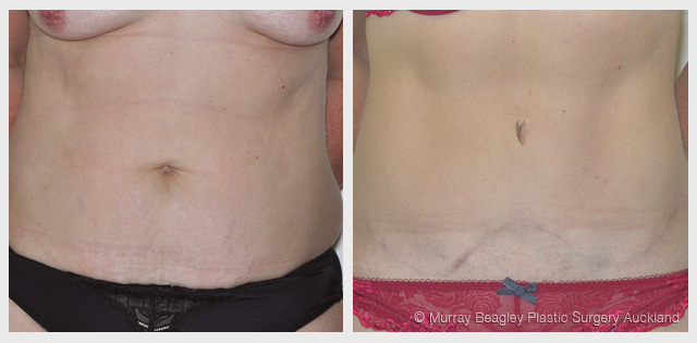 before after Abdominoplasty tummy tuck surgery