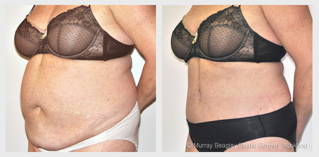 before after Abdominoplasty tummy tuck surgery