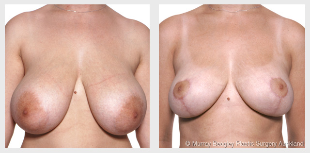 breast reduction before after surgery