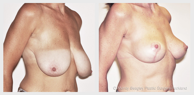 breast reduction before after surgery