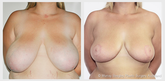 breast reduction before after surgery