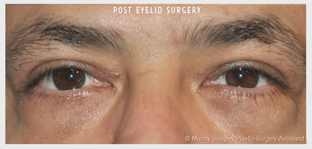 Blepharoplasty Eyelid surgery Plastic Surgery Auckland