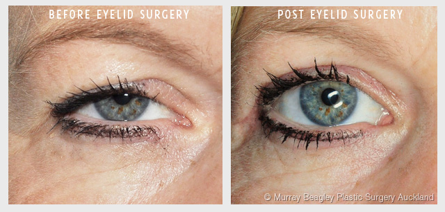 Blepharoplasty Eyelid surgery Plastic Surgery Auckland