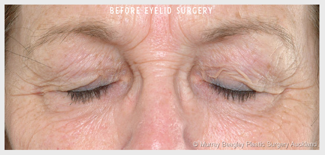 Blepharoplasty Eyelid surgery Plastic Surgery Auckland