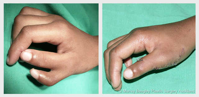 hand surgery
