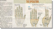 Surgical team saved boy's hand