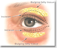 eyelid cosmetic surgery Auckland