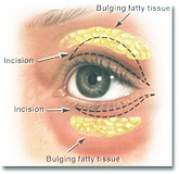 Eyelid surgery