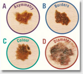 melanoma cancer surgery guidelines