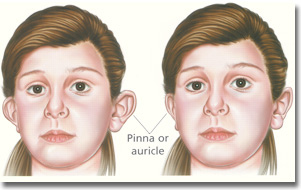 Otoplasty, prominent ear surgery