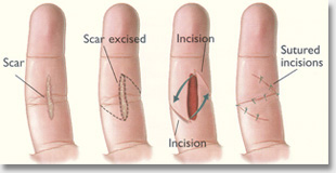 Scar Revision Surgery Auckland