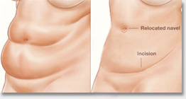 tummy tuck - abdominoplasty Auckland