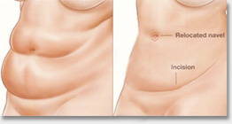 Tummy Tuck cosmetic surgery